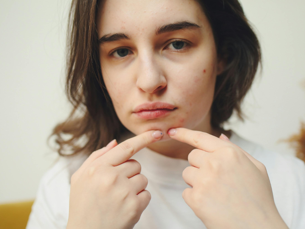 Combien de temps faut-il à l'Isotrétinoïne 20 mg pour éliminer l'acné ?